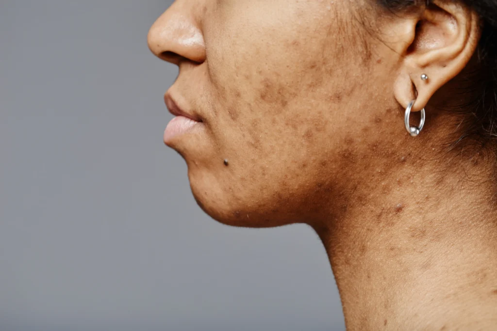 Peeling químico