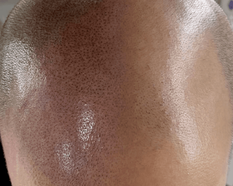 Micropigmentación Alopecia (técnica Scalp) 