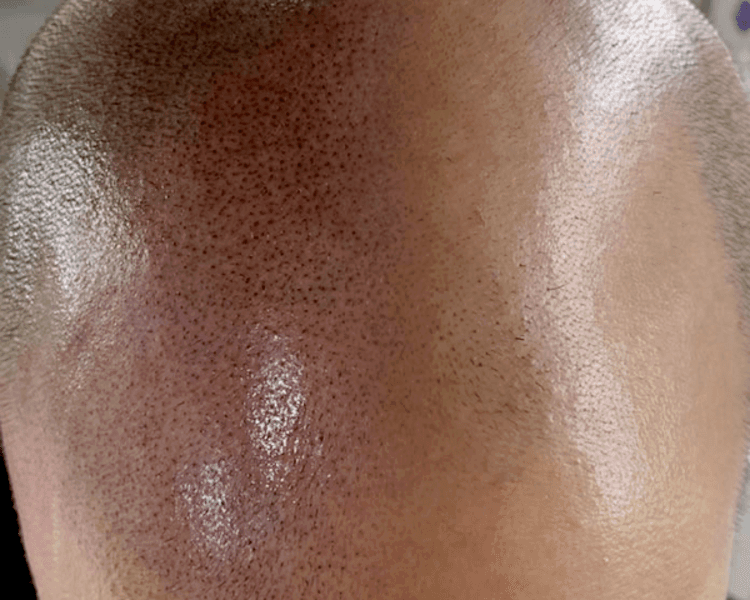 Micropigmentación Capilar (técnica Scalp o Pelo por pelo ) Método Esencia®