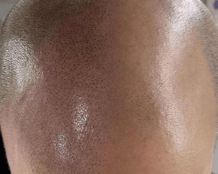 Micropigmentación Alopecia (técnica Scalp) 