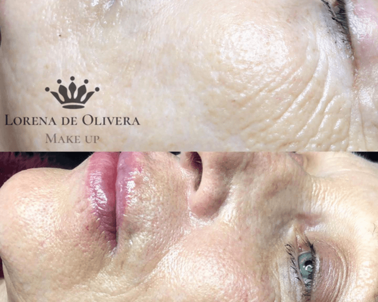 Limpieza + Micronnedling (inducción de colágeno)+ Fototerapia (tratamiento Anti edad)