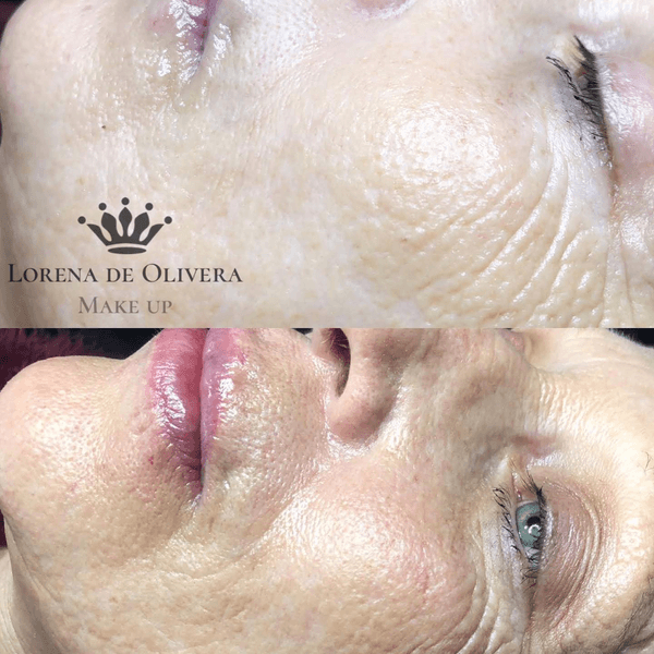 Limpieza + Micronnedling (inducción de colágeno)+ Fototerapia (tratamiento Anti edad)