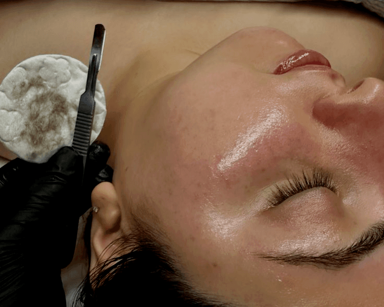 DERMAPLANING