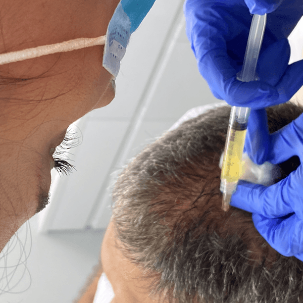 Plasma Rico En Plaquetas + Dermapen 