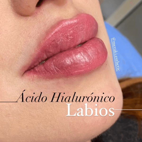 Ácido Hialurónico  Labios 👄  1ml