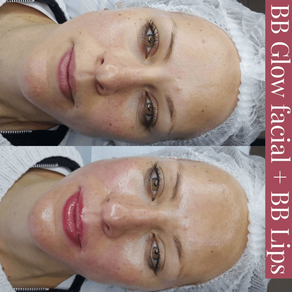 Higiene facial c/ dermapen y EXOSOMAS - 1 sesion