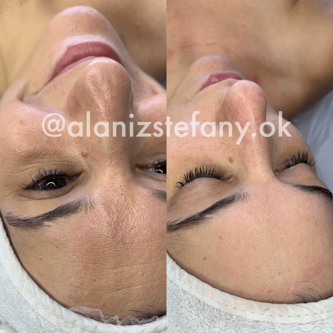 Simil botox  - 1 sesión