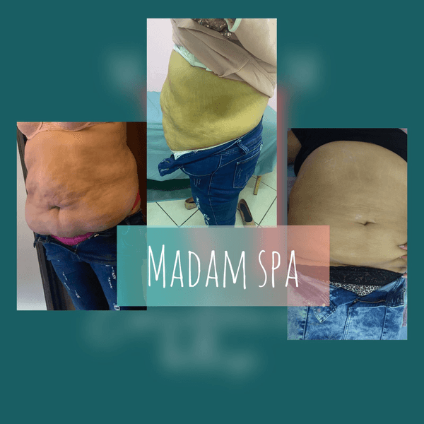 CARBOXITERAPIA Y APARATOLOGIA 5 EQUIPOS / 1 SESION