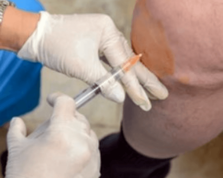 Tratamiento Intraarticular Células Madre