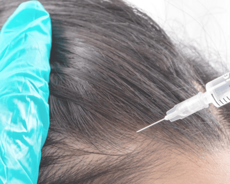 Rejuvenecimiento Facial Plasma Rico en Plaquetas ( PRP) sesión única