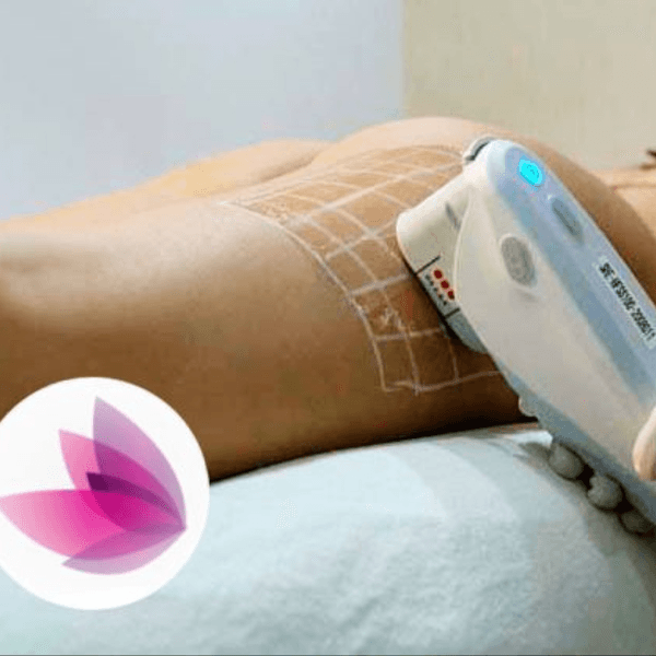 HIFU en Zonas Corporales