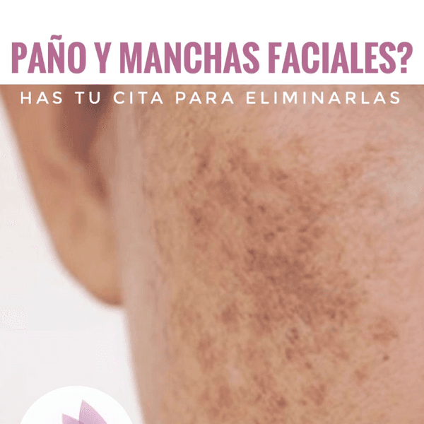 Sesion Laser para Manchas Faciales 