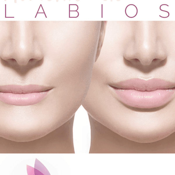 Relleno de Labios con Ac Hialurónico