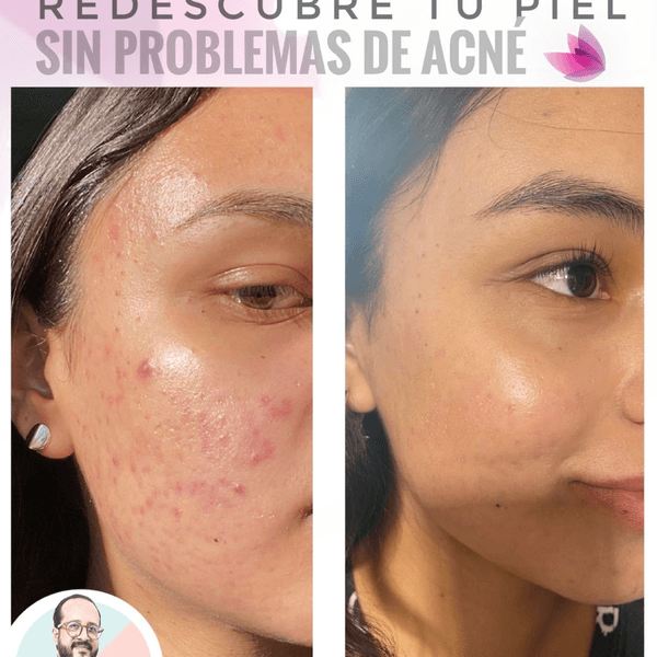 Tratamiento Laser Anti-Acné