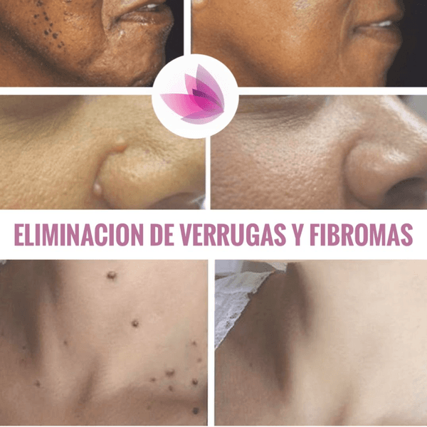 Eliminación de Lunares y Verrugas