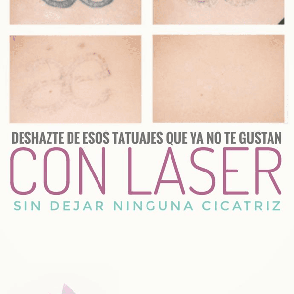 Eliminación de Tatuajes con Laser 