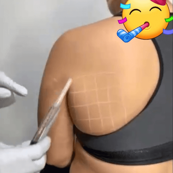 MINI LIPO SIN CIRUGIA: ADM. ENZIMAS LIPOLITICAS (1 ZONA)