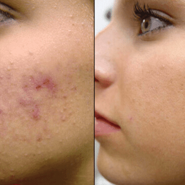 FACIAL-PEELING ACNE