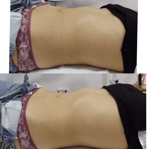 Drenaje linfático Abdomen técnica brasileña 