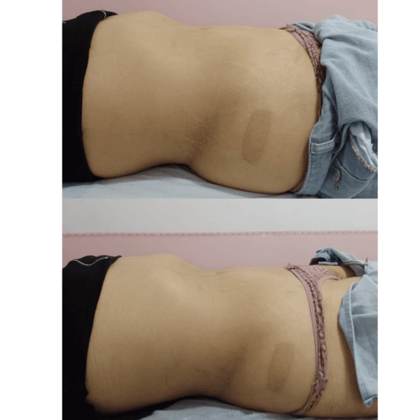 Drenaje linfático modelador Abdomen con aparatología