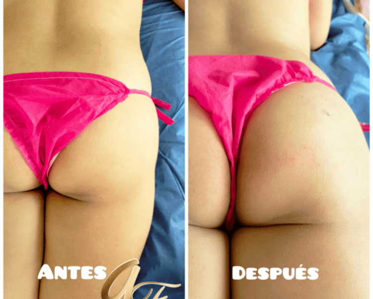 AUMENTO Y MOLDEO DE GLÚTEOS CON PLASMA GEL