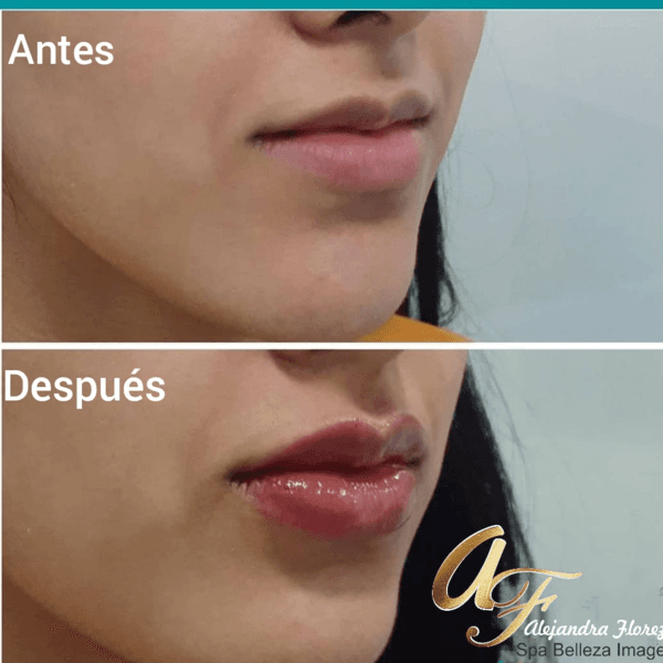 PERFILAMIENTO DE LABIOS 
