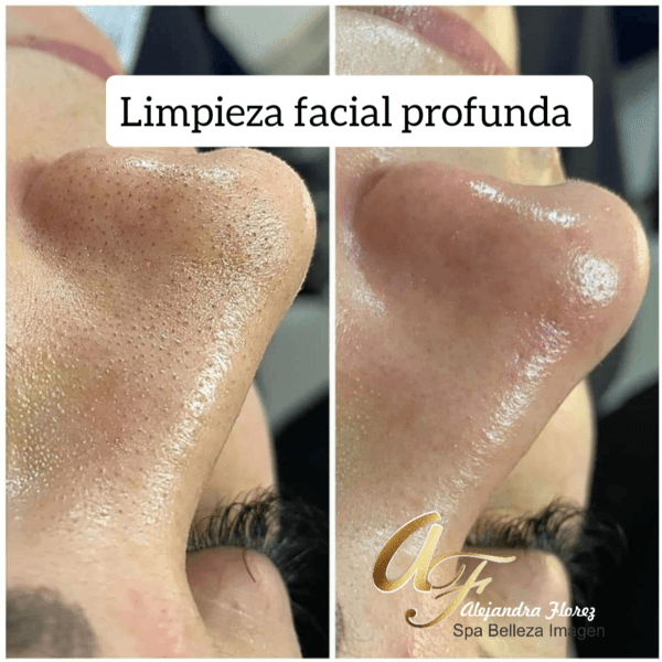 LIMPIEZA FACIAL PROFUNDA
