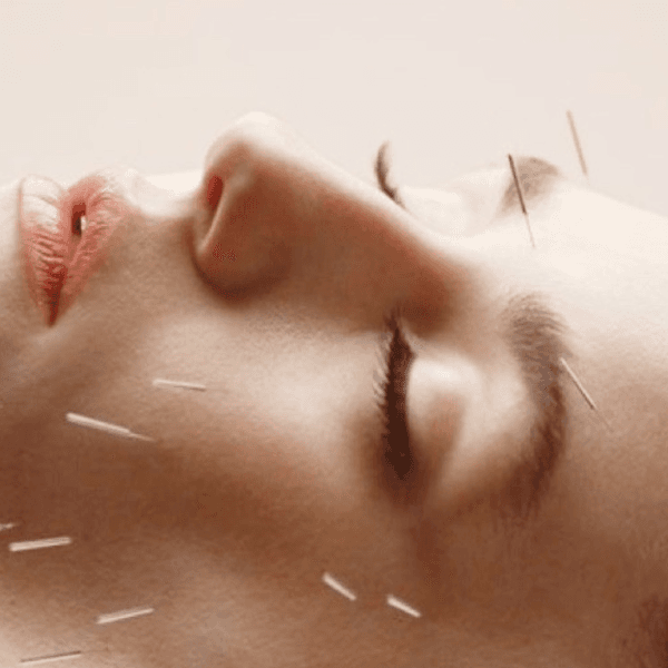 Lifting Facial con Acupuntura
