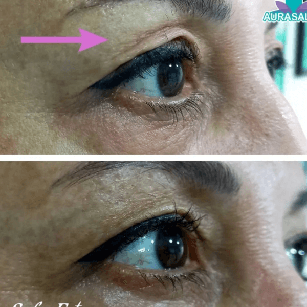 Blefaroplasma párpados superiores e inferiores con Plasmage