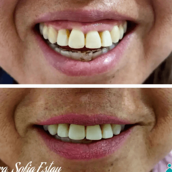 Botox sonrisa gingival