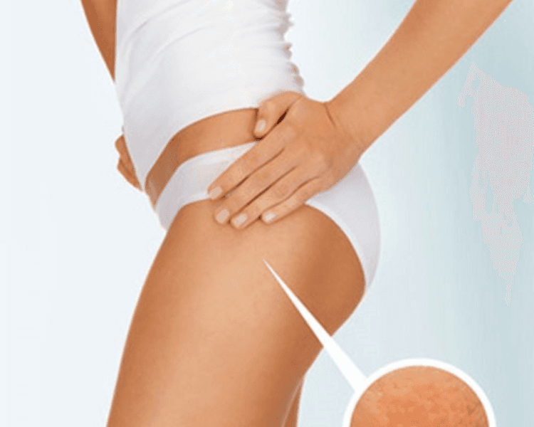 Pack X4 sesiones  (Celulitis )