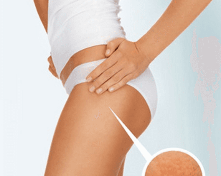 Pack X4 sesiones  (Celulitis )