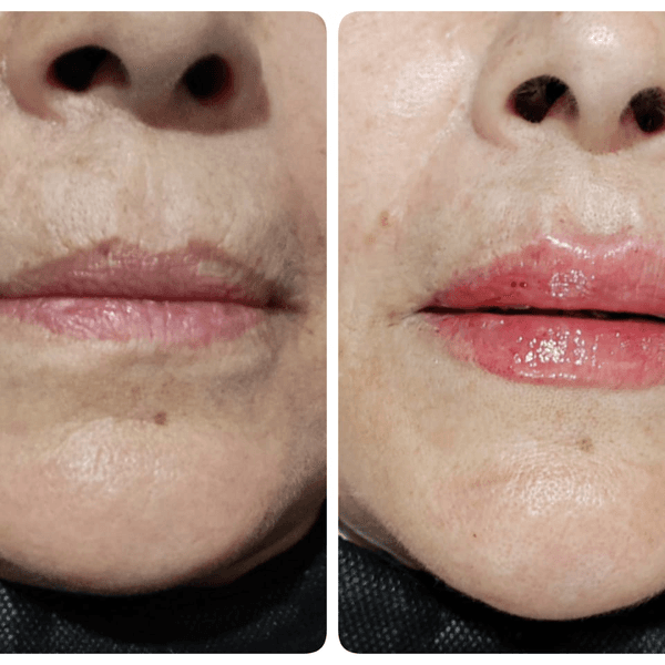 Ácido Hialurónico labios