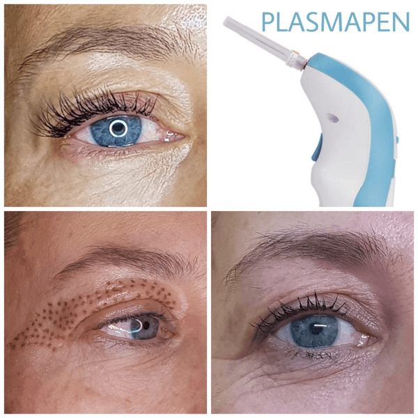 Tratamiento para marcas de acne