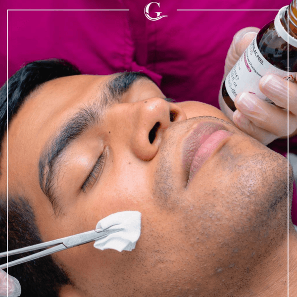 Peeling Facial Dermatologico ( piel renovada)