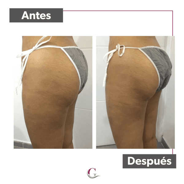 Paquete Levantamiento de gluteos (10 sesiones) 