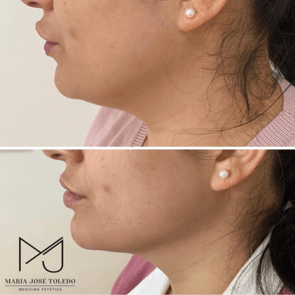 Lipodisolución de papada