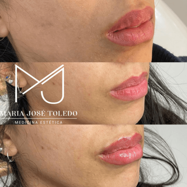 Disolución con hialuronidasa