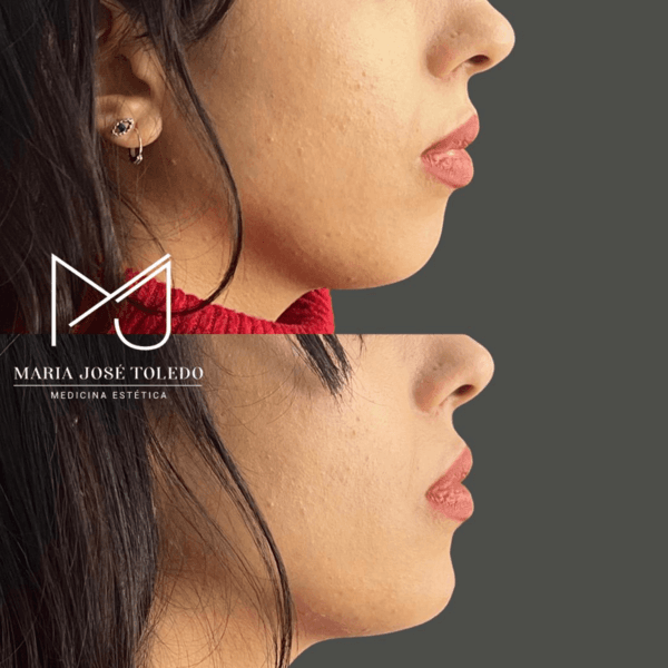 Bioplastia de mentón