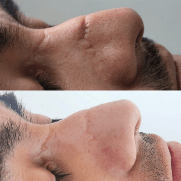 Tratamiento Plasma para cicatrices (1S)