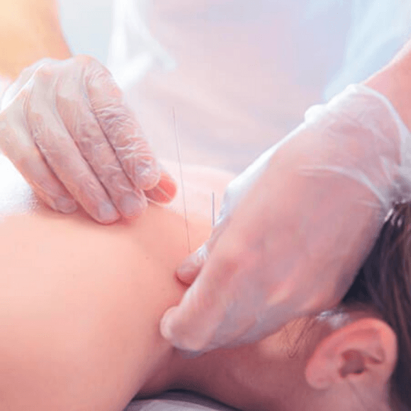 PUNCIÓN SECA 5 SESIONES