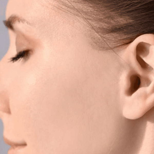 Depilación de Patillas Sistema Español