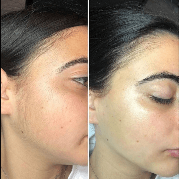 Depilación de rostro