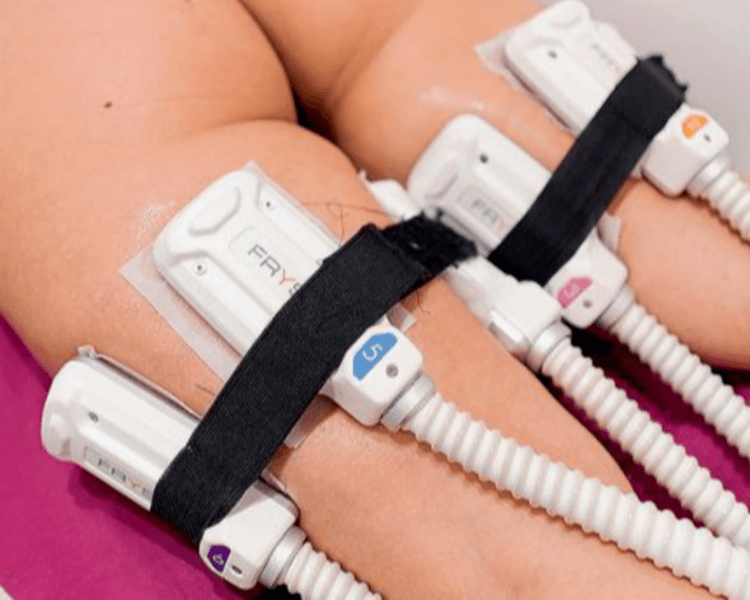 Criolipolisis + masajes