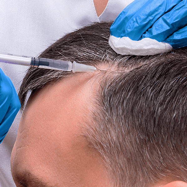 Mesoterapia capilar full