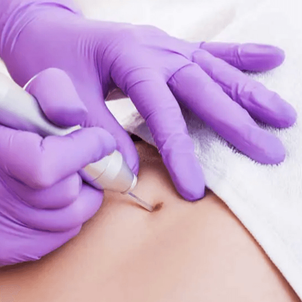 CAUTERIZACION LUNARES Y MAS