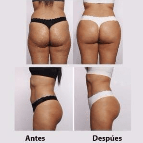 VACUMTERAPIA EN GLUTEOS