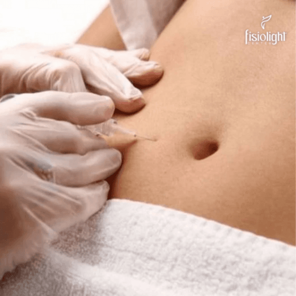 CARBOXITERAPIA ABDOMEN