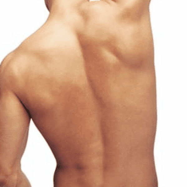 Depilación Espalda Hombre