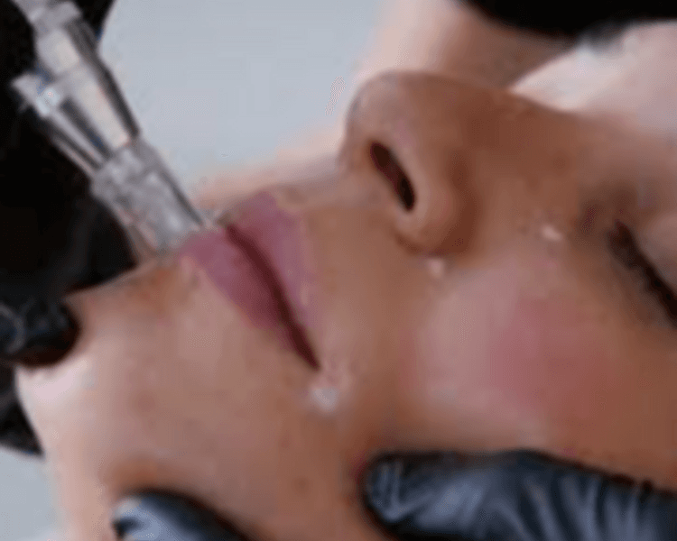 Dermapen para Contorno de Labios